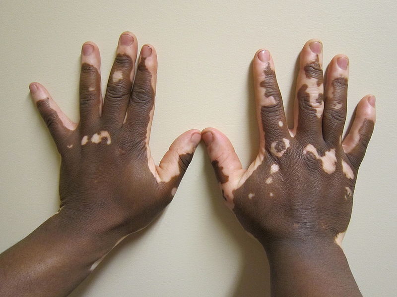 Vitiligo hands. From Wikipedia, the free encyclopedia. Creative Commons Attribution-Share Alike 3.0 Unported License